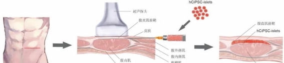 干细胞再生疗法为1型糖尿病治疗带来新希望