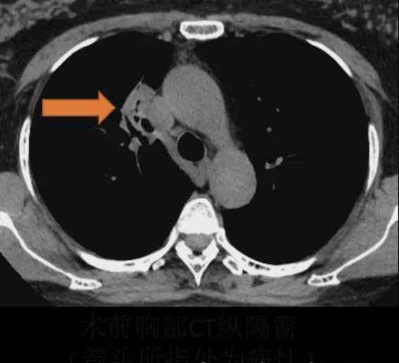 气管镜下超声小探头：胸外科的诊断新篇章