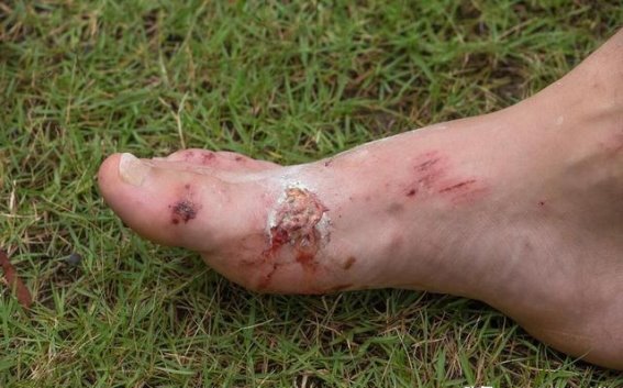 脚趾健康：糖尿病的隐秘信号