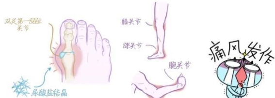 尿酸偏高却无痛风症状：是否需要药物治疗？