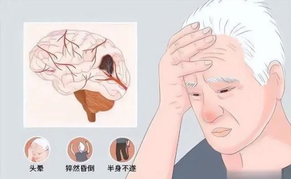 脑供血不足的常见症状及改善方法详解