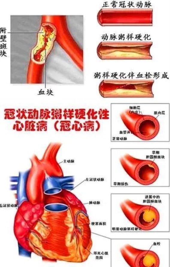 35岁公务员如何因冠心病重塑生活方式：深度解析与建议