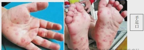 秋季出游防病指南：谨防常见传染病