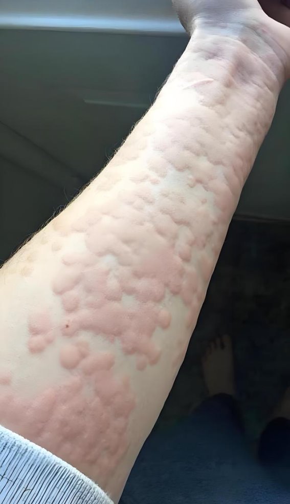 阿莫西林的真相：你了解它的真正用途吗？