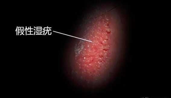 假性湿疣的认识与治疗：了解其与HPV的关系