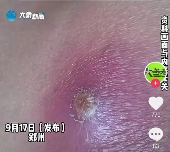 挤破痘痘竟引发重症，警惕这些常见误区